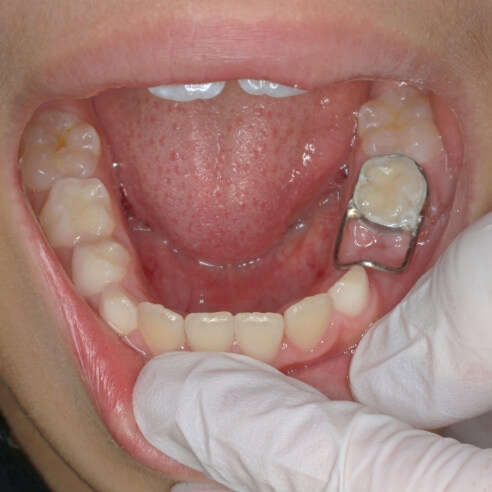 歯がなくなった部分のスペース保持の治療の例