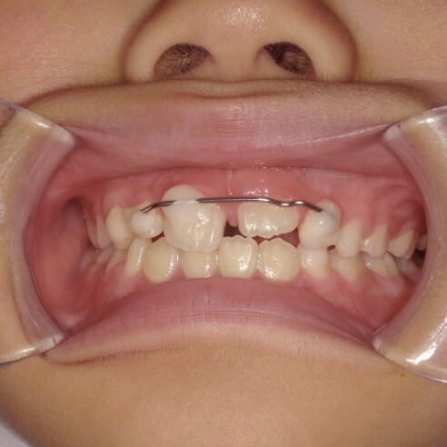 歯をぶつけた処置の例
